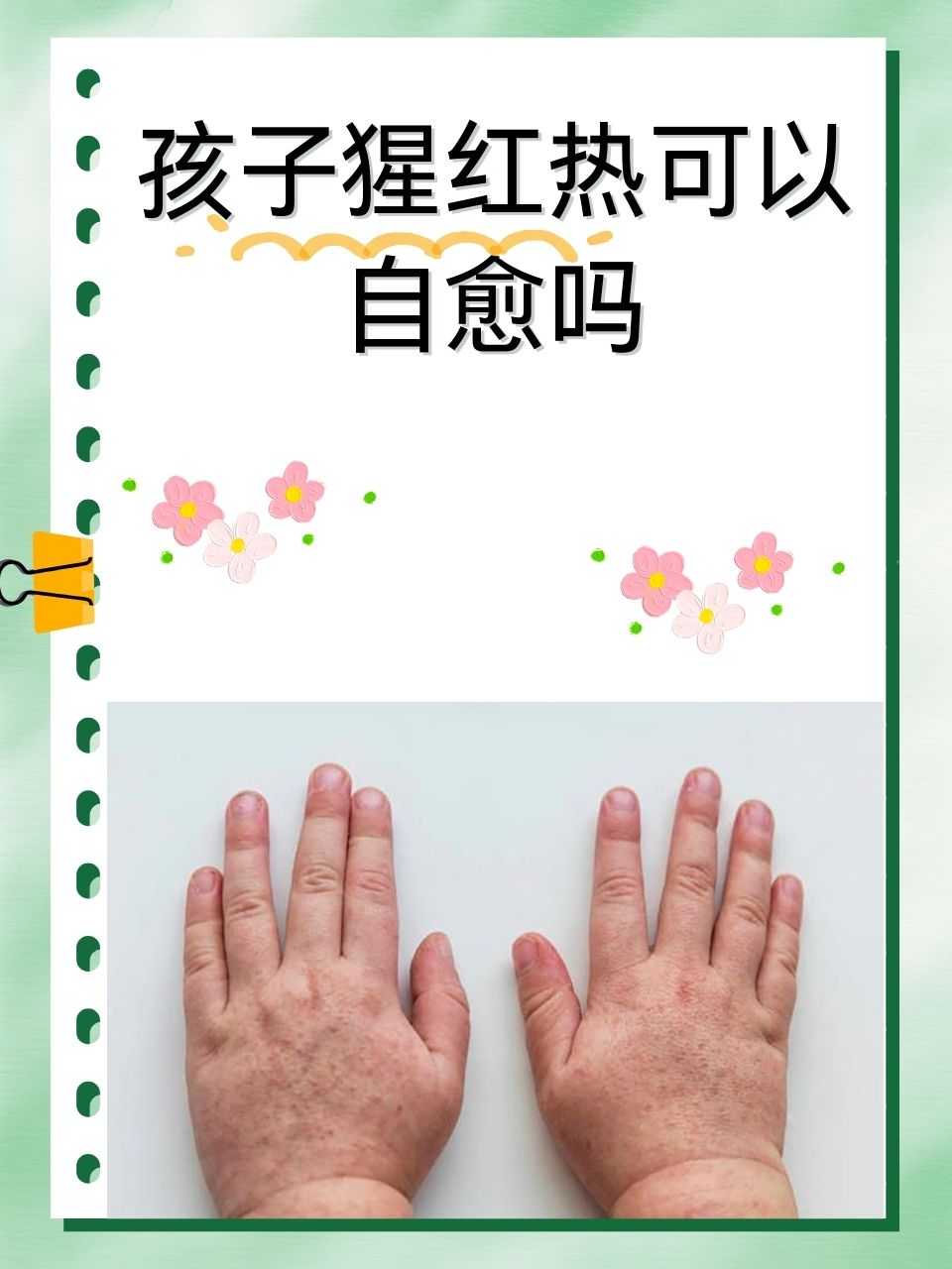 猩红热作为一种常见的儿童传染病,让许多家长忧心忡忡