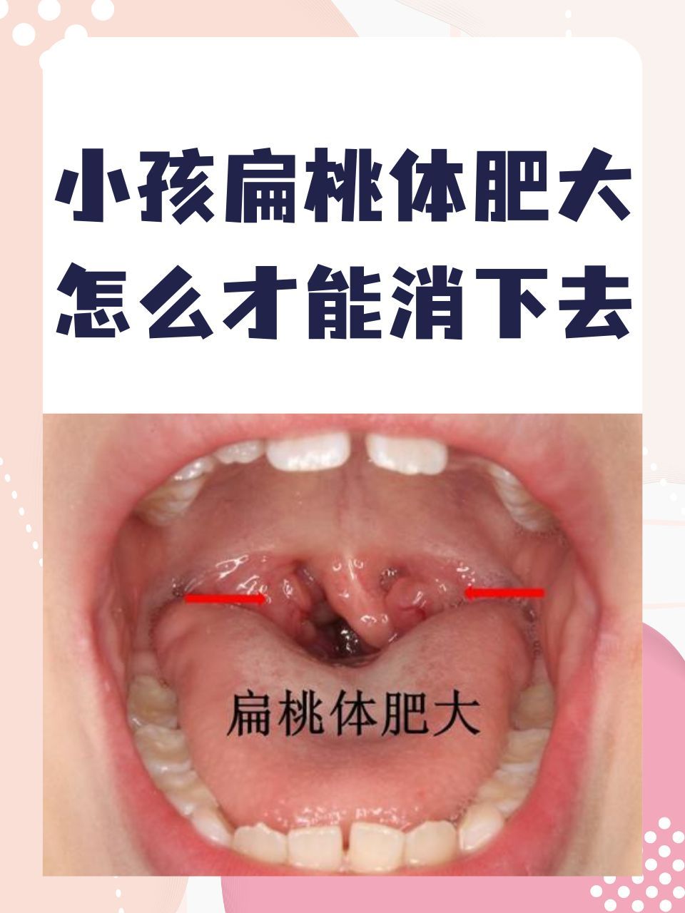 小孩扁桃体肥大怎么才能消下去