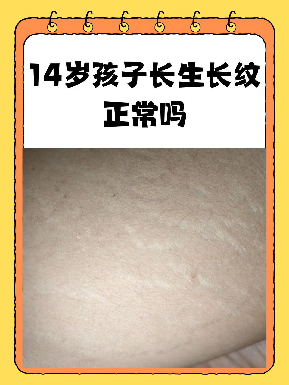 当14岁的孩子身上开始出现生长纹时,不少家长可能会感到担忧和疑惑