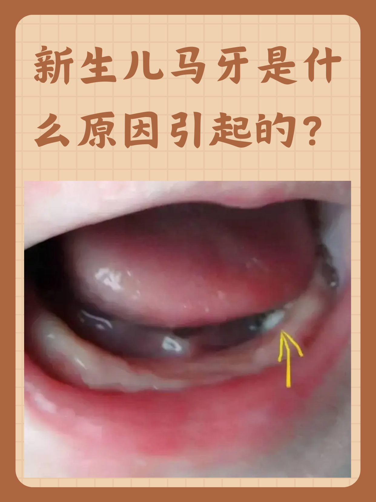 新生儿马牙是什么原因引起的?
