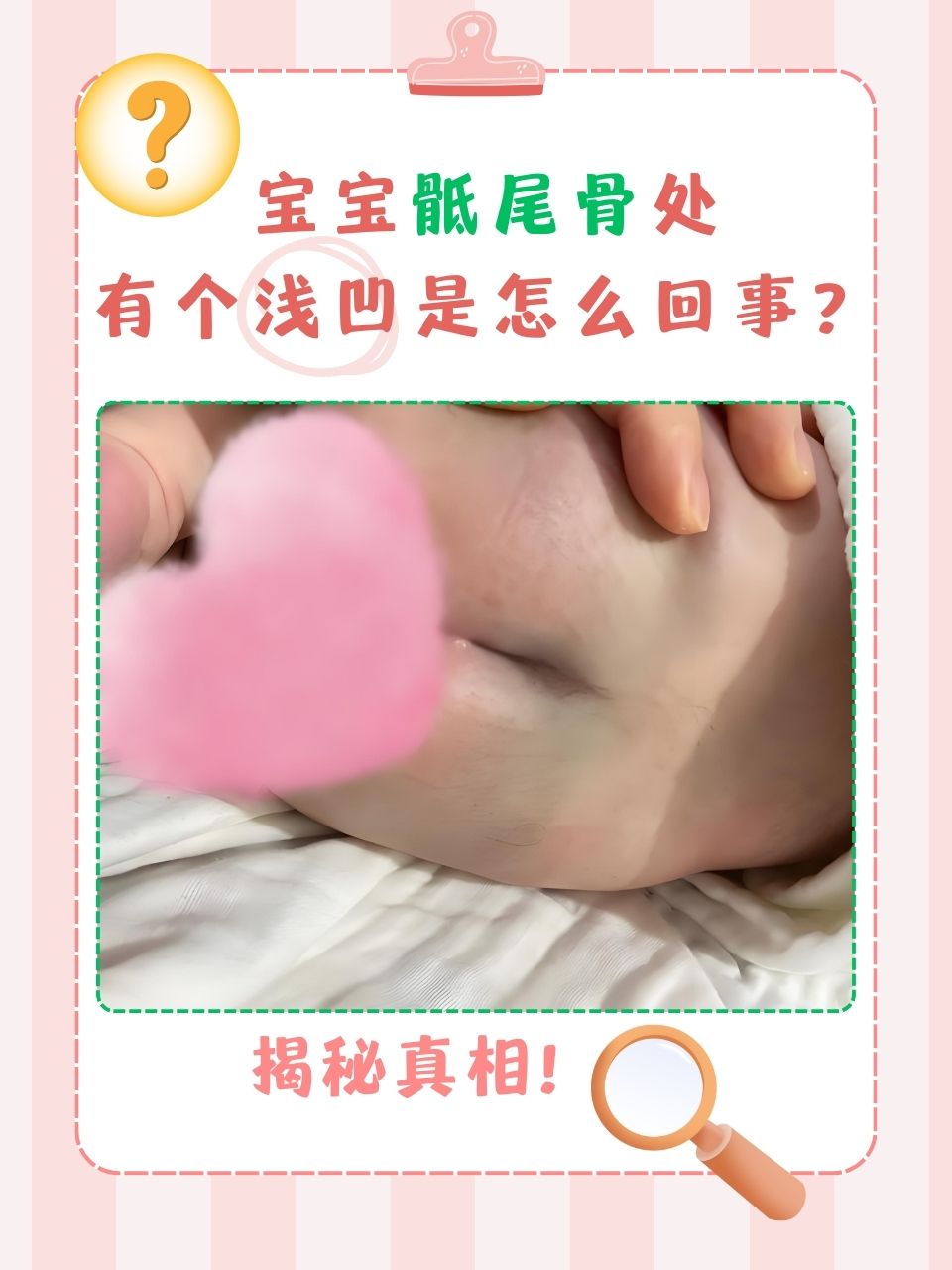 宝宝骶尾骨处有个浅凹是怎么回事?
