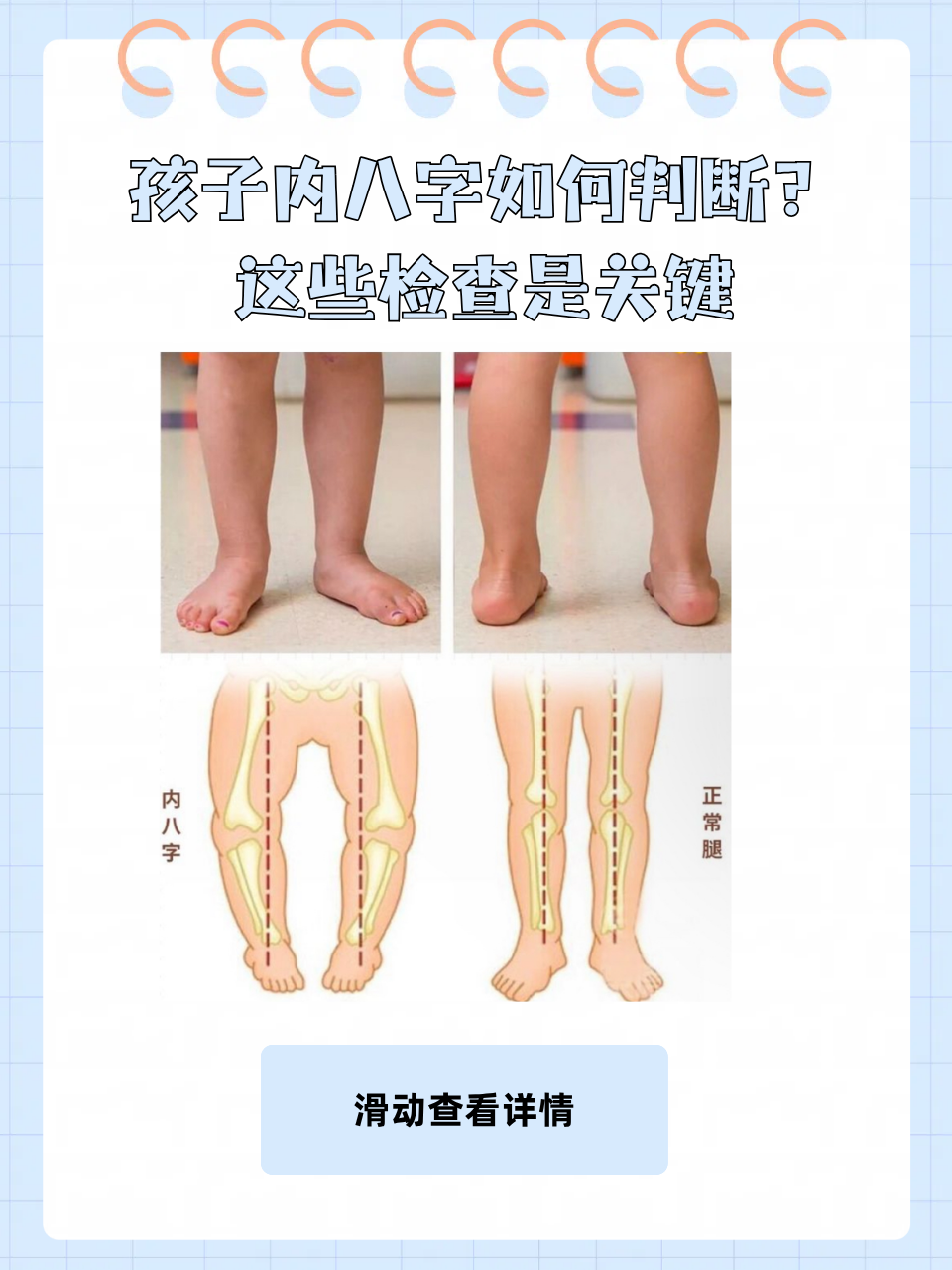 不少家长担心这是内八字,但又不知如何判断