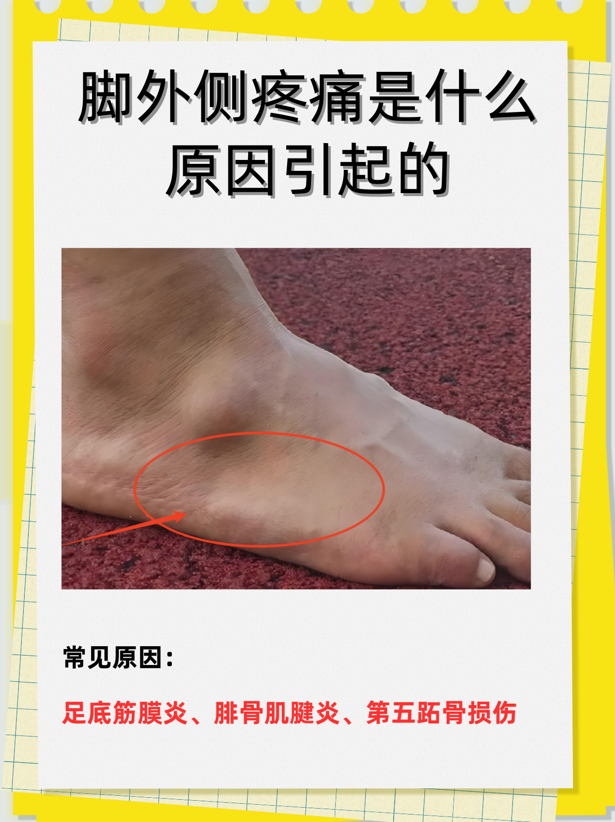 炎位置图片第五跖骨肌腱疼痛脚外侧疼蔓延到 
