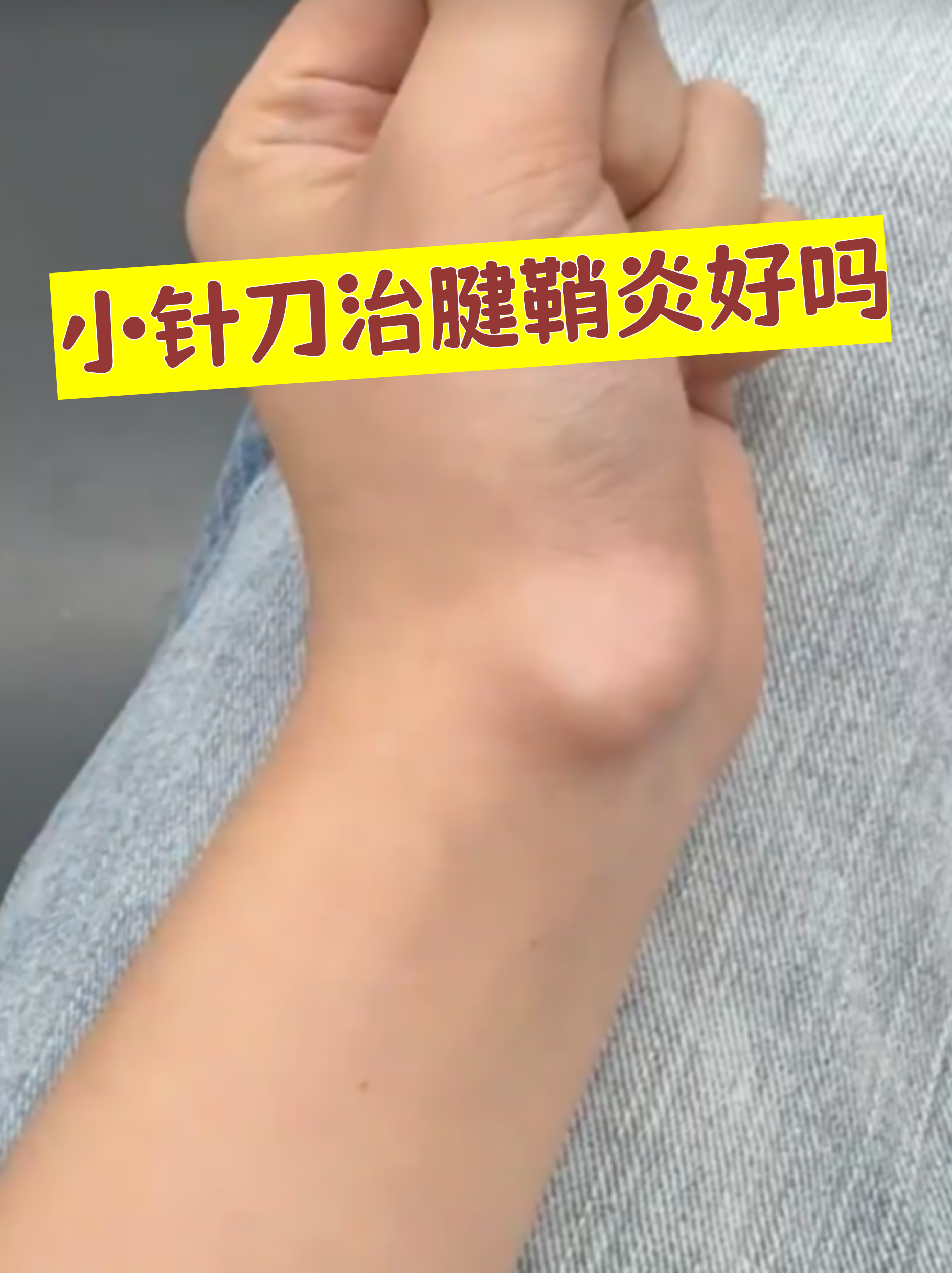 小针刀治疗腱鞘炎的效果因人而异,但确实是一种