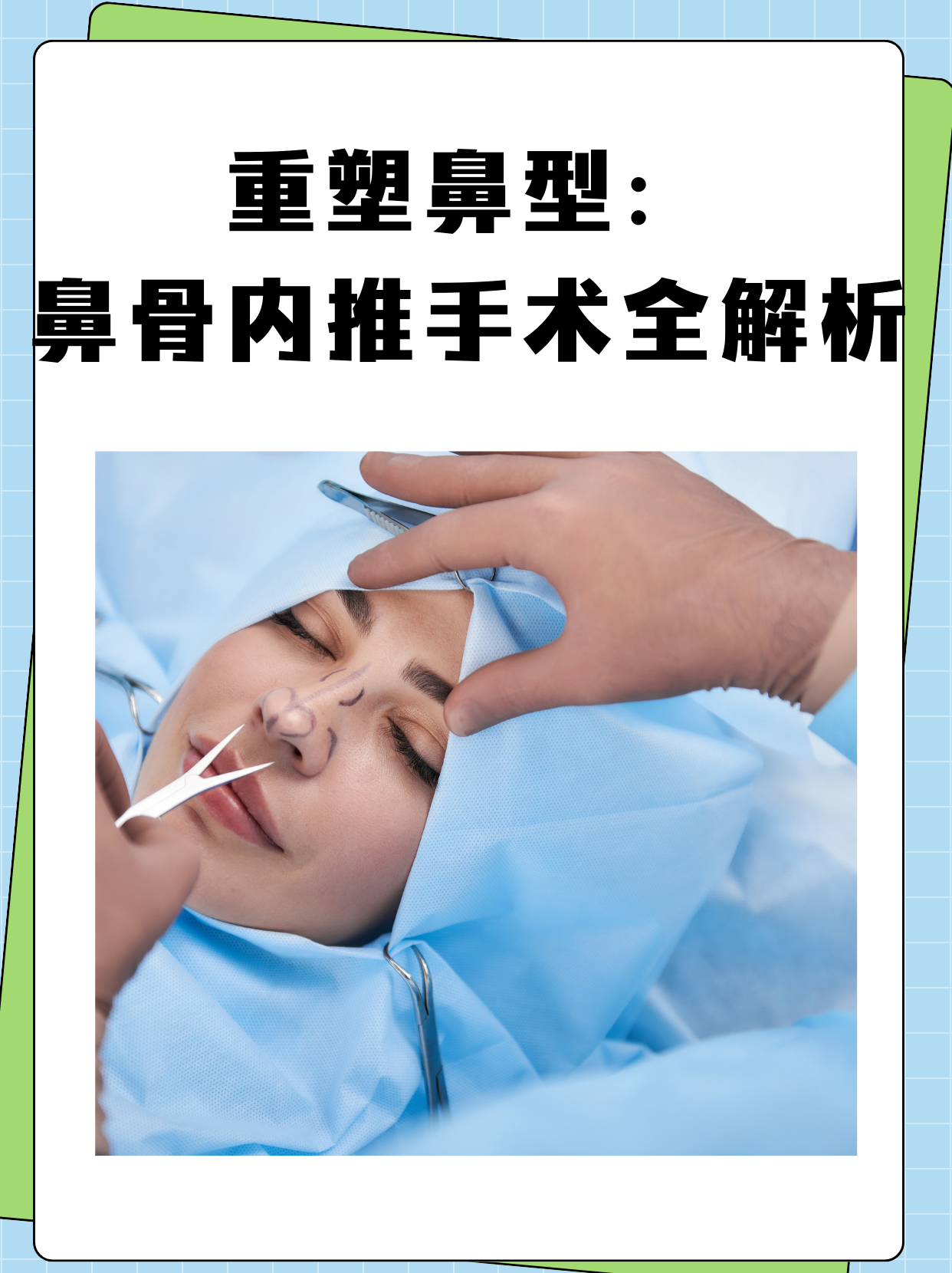 重塑鼻型:鼻骨内推手术全解析[加油] 鼻骨内推手术,是通过手术方式将