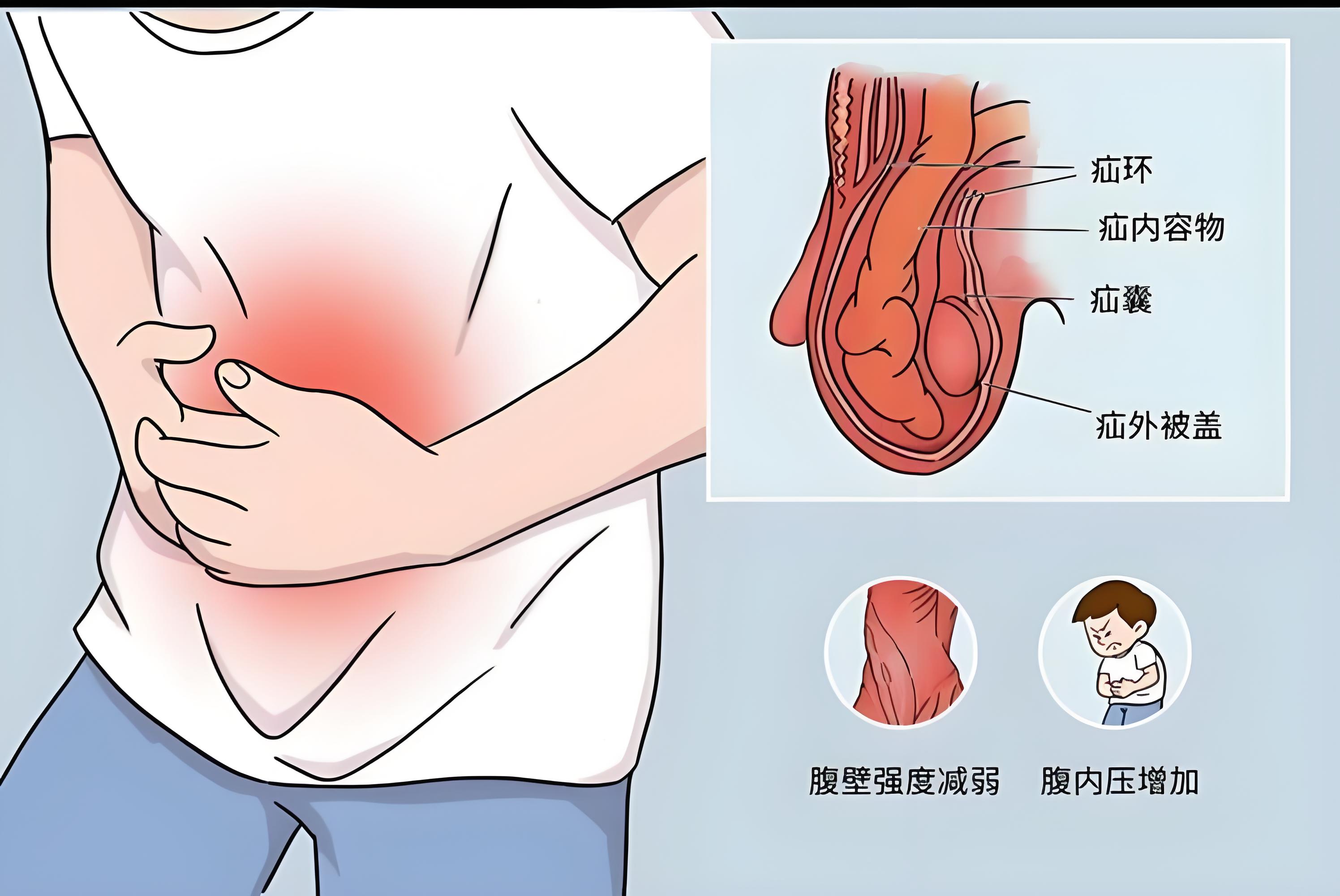 总有人想着 疝气  不手术也可以治愈