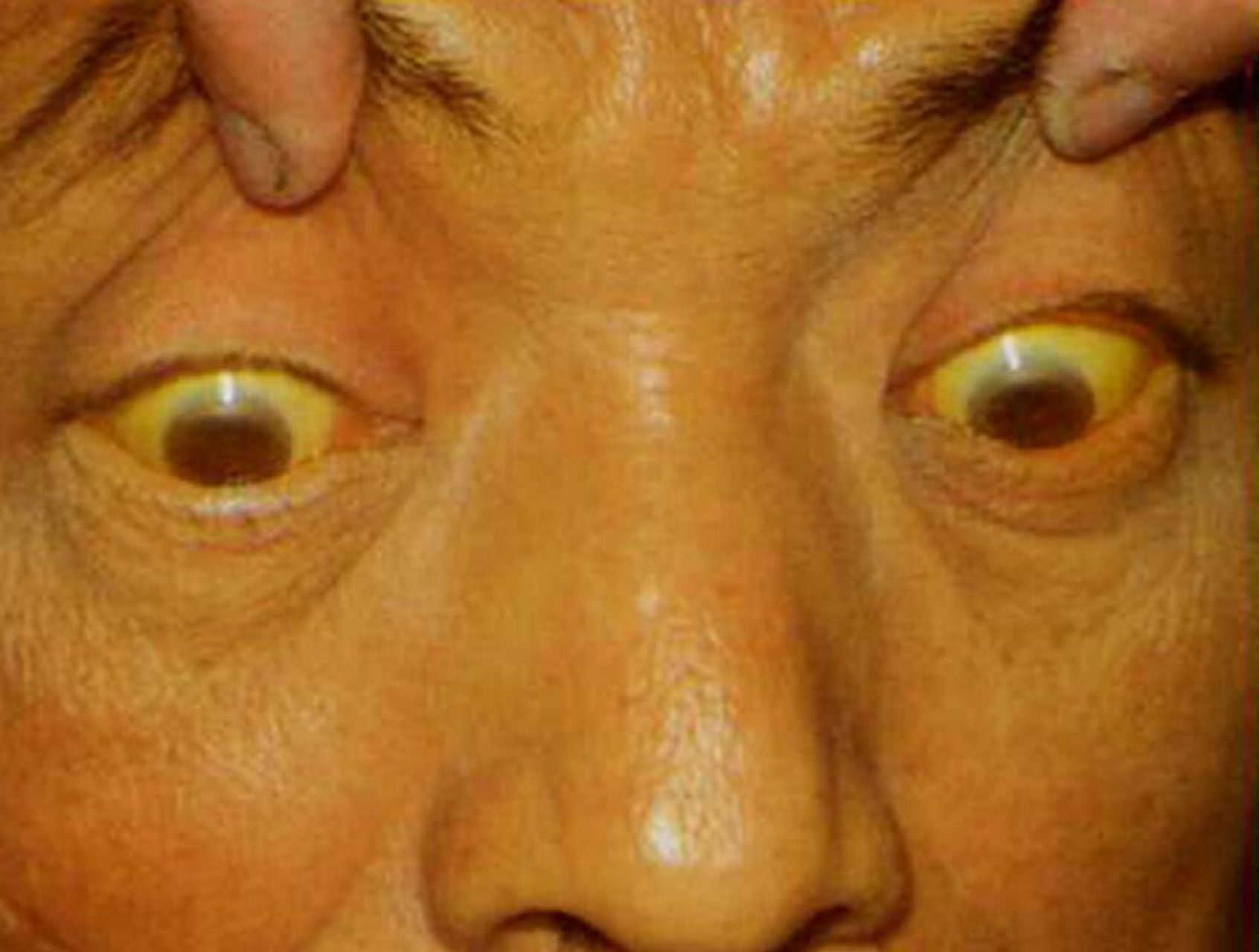 1,巩膜发黄:这是胆红素上升严重引起的,最先表现在巩膜上,同时还