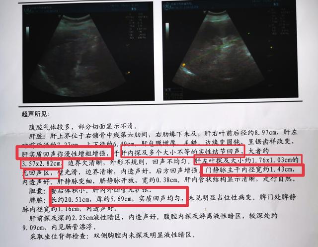 三,肝门静脉增宽 四,胆管扩张与血流异常 #乙肝# #肝硬化# #肝癌# #不