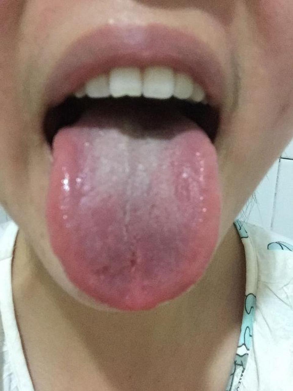 为您详细解读肝郁气滞,阴虚火旺,脾胃虚寒的舌苔表现,并