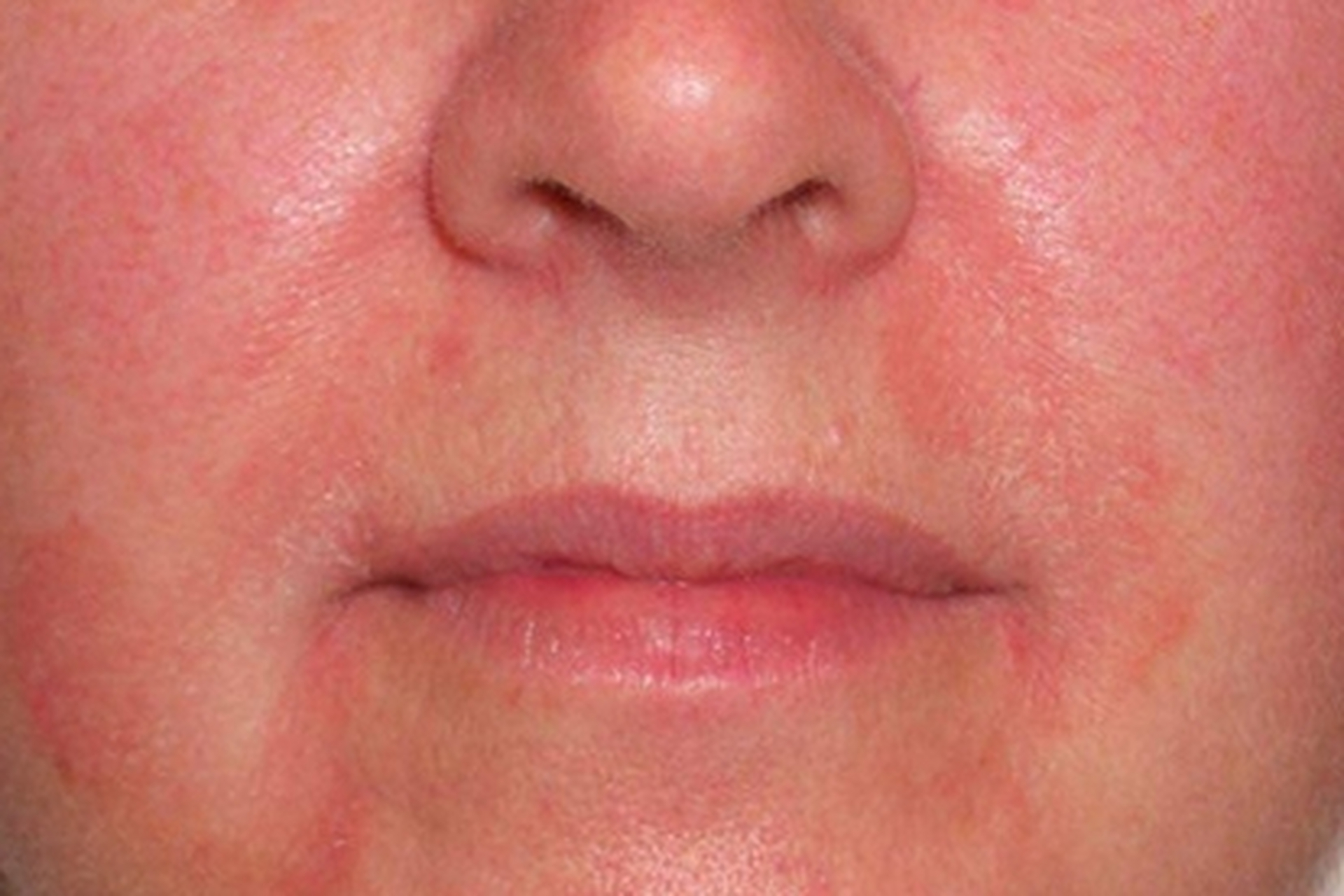 如果是面部的脂溢性皮炎,鼻子顶着一些油腻的鳞屑,可以外用此美木司