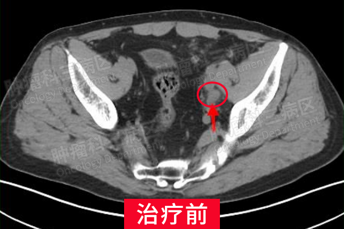 尿色转清,尿血改善,腹痛 膀胱癌血尿图气肿性膀胱炎ct横断面与矢状面