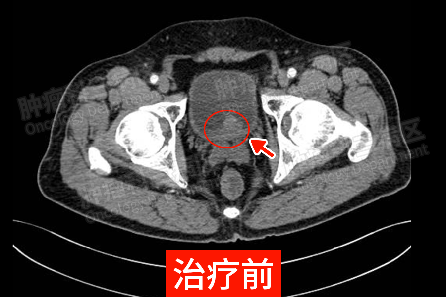 来自贵州63岁李大叔,因为尿频,血尿等症状去医院检查不幸确诊膀胱癌