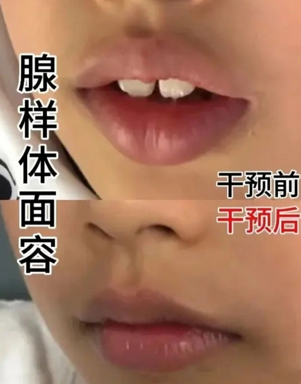 孩子腺样体肥大  【分析原因】 外因:空气污染,过敏原刺激,病毒细菌