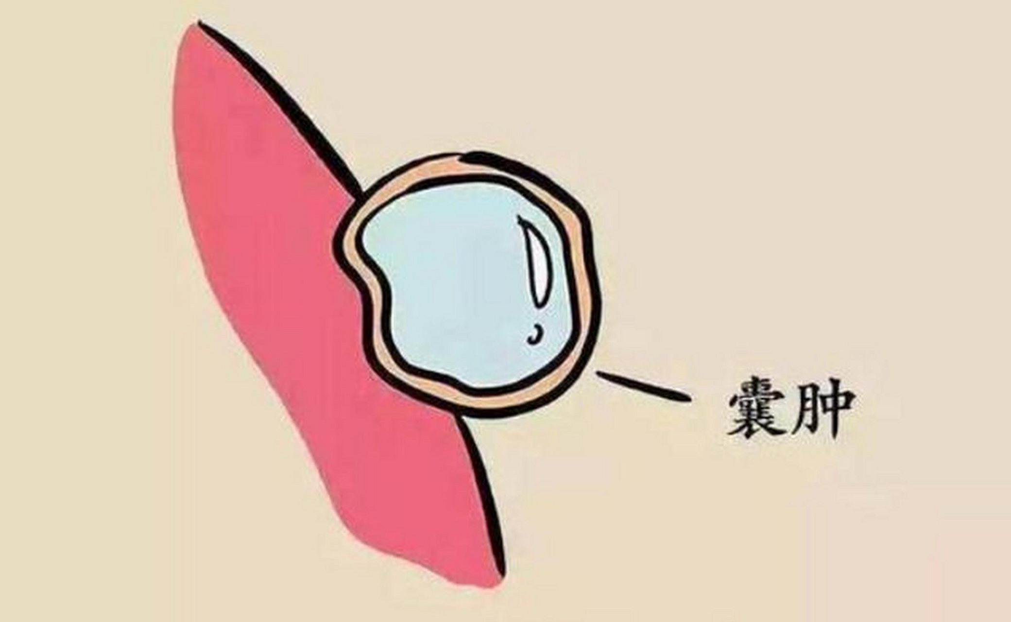 肝囊肿分为先天性肝囊肿和后天性肝囊肿.