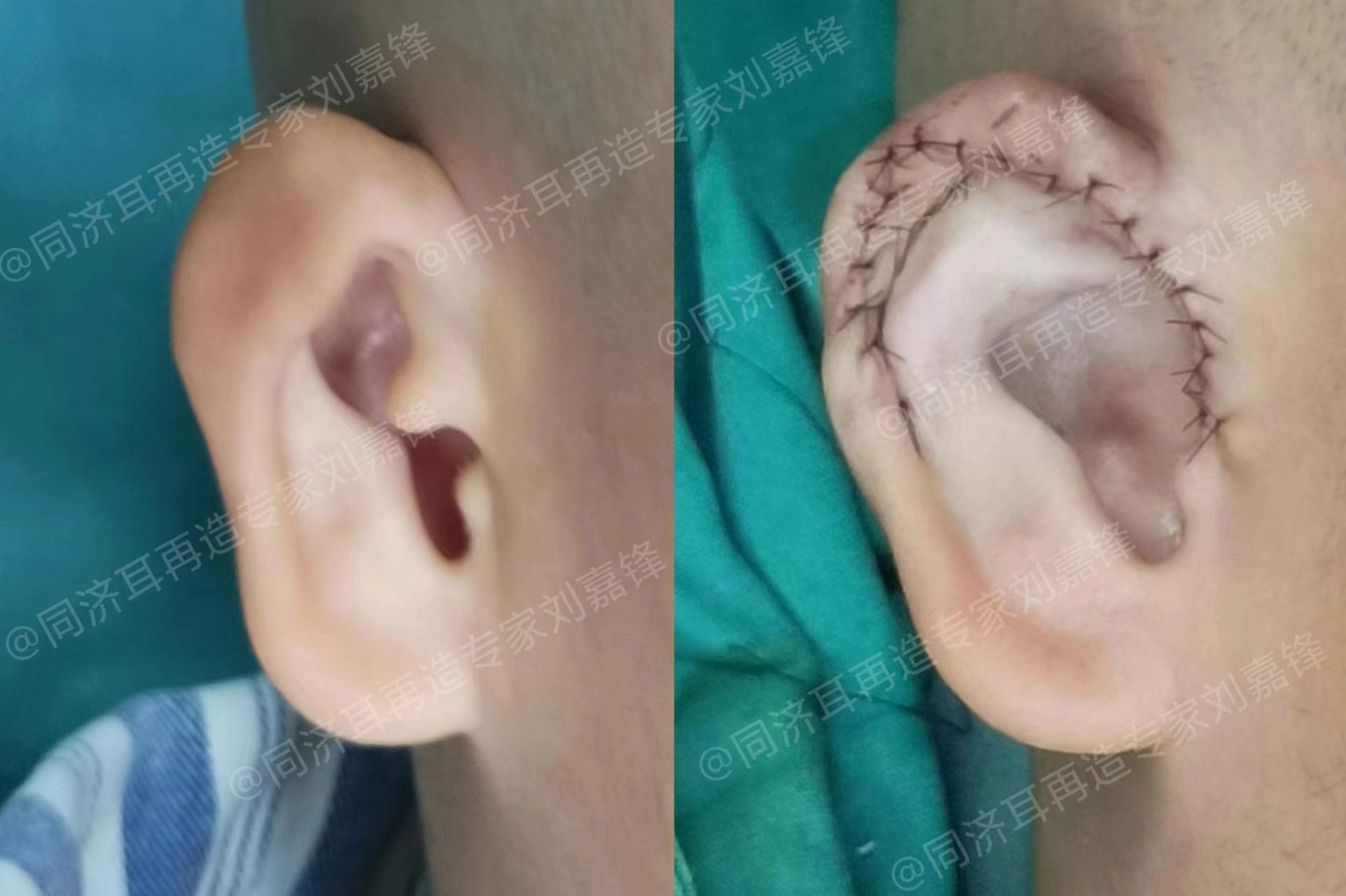 很多小耳畸形的孩子都是没有耳道的,但是这并不影响他们的听力,因为