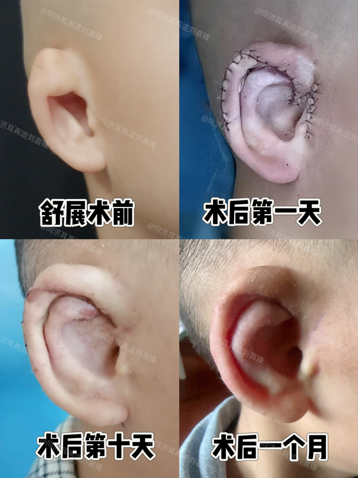 软骨取变形图片耳畸形矫正对比图2度耳朵畸形图片耳缺损修复案例图片