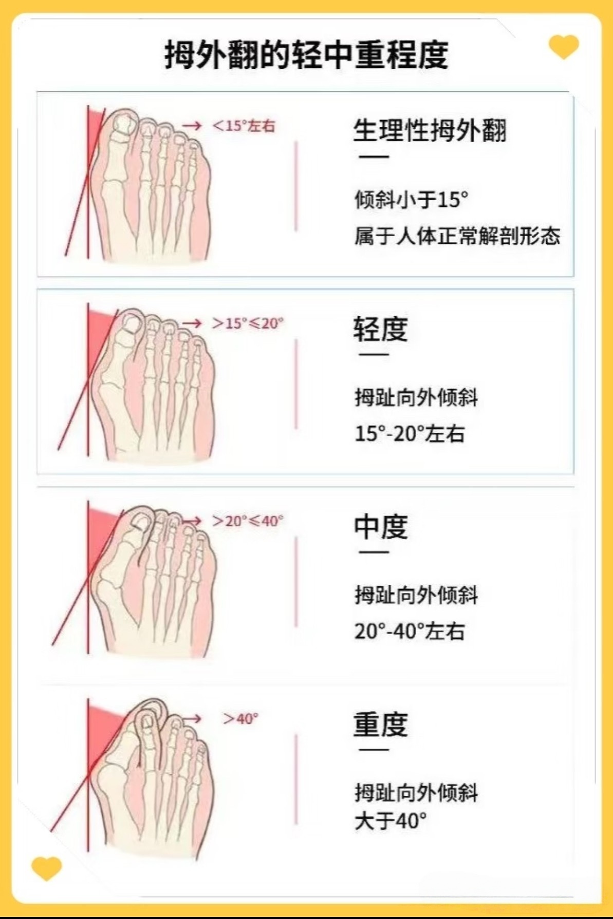 拇外翻是一种常见的足部畸形问题,它的形成原因多种多样.像