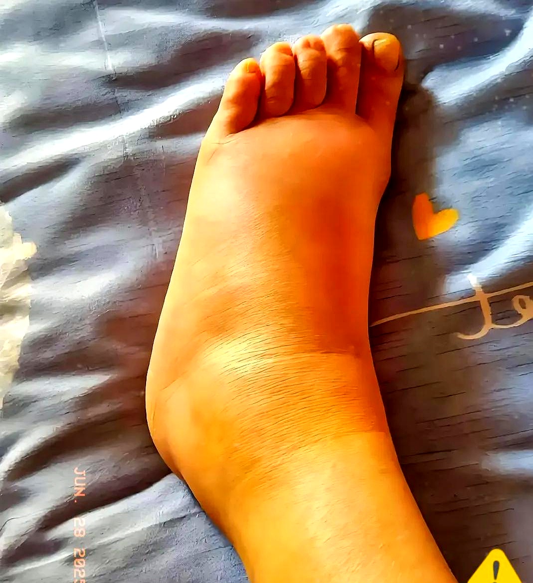 图片脚浮肿图片真实比较真实的脚肿图片男人痛风的图片脚肿患者的照片