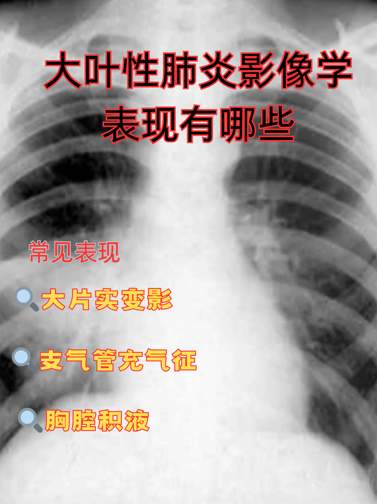 大叶性肺炎影像学表现有哪些