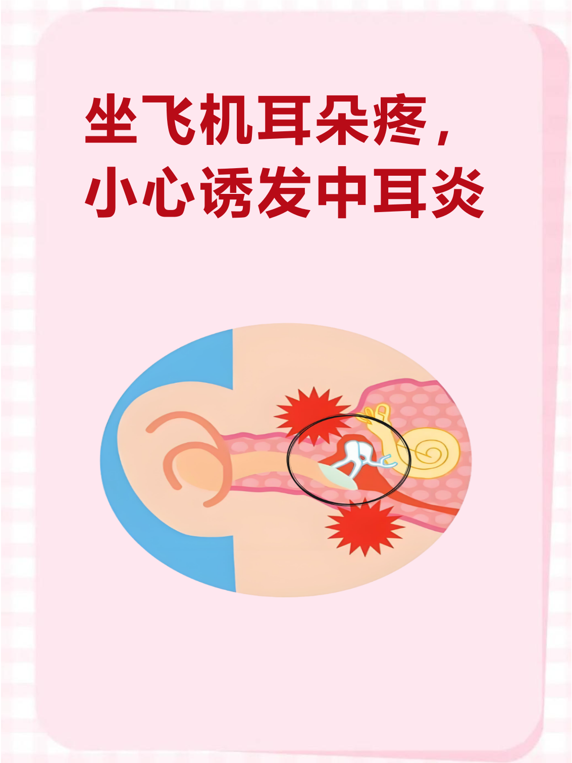 坐飞机耳朵疼,小心诱发中耳炎