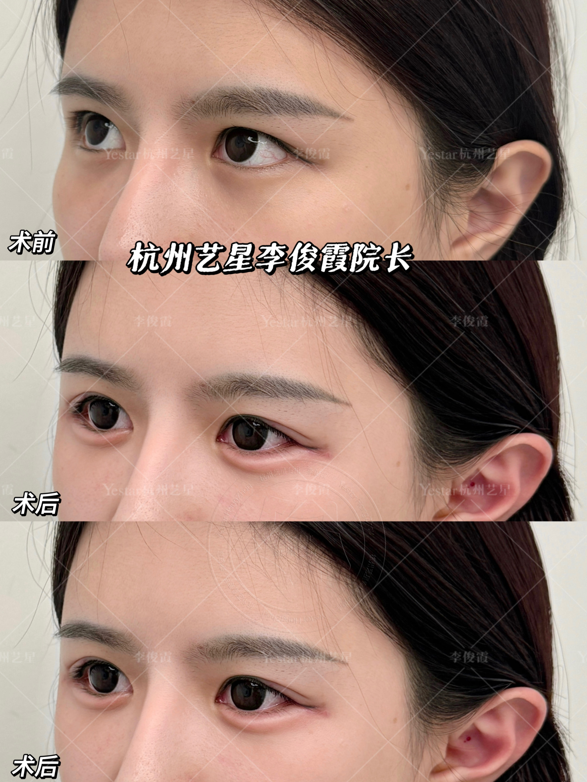 超自然微开扇卧蚕自带温柔滤镜眼神灵动迷人 李俊霞眼周年轻化