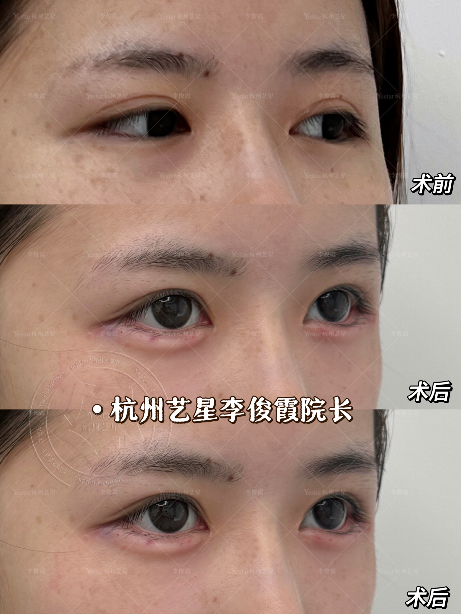 漫画少女眼打造 妈生卧蚕 放大双眼凸显温柔灵动气质～眶周结构重塑