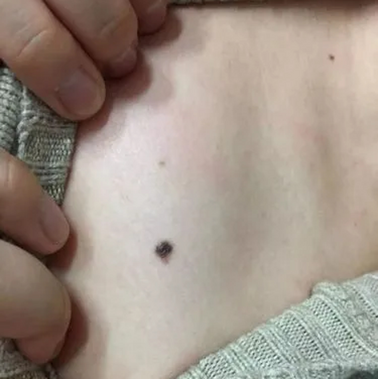 判断黑点是否为痣,可观察其形态,颜色,生长年龄,并进行皮肤镜和组织