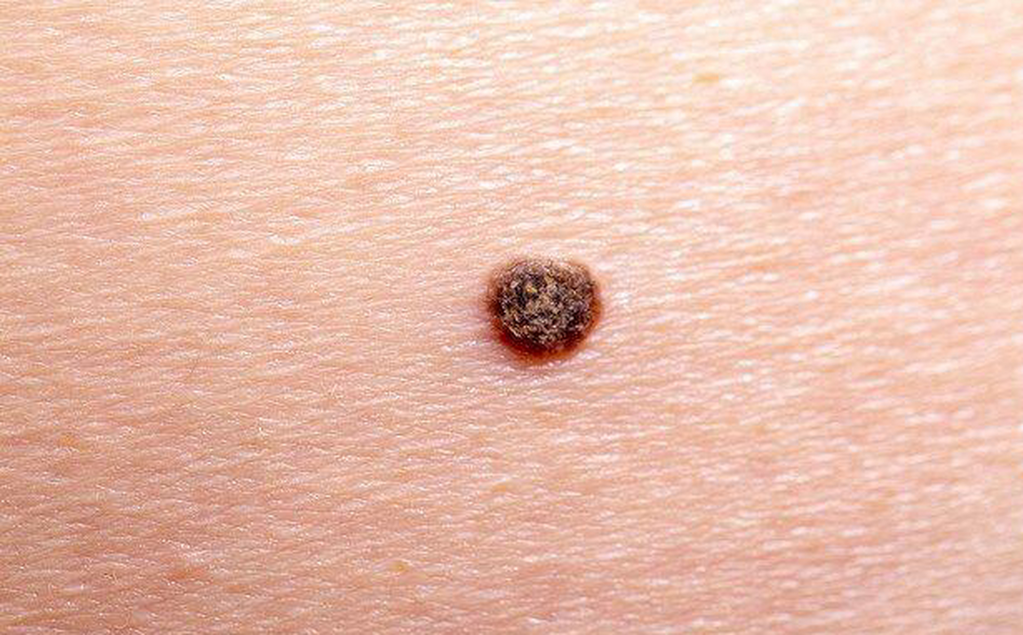 首先痣是光滑的,黑色素瘤形状不规则;第二,痣一般是黑色和褐色,黑