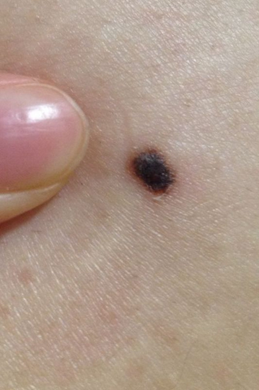 身上的黑痣经常性发痒,但又发现有明显的变大增厚,这是恶变了吗?