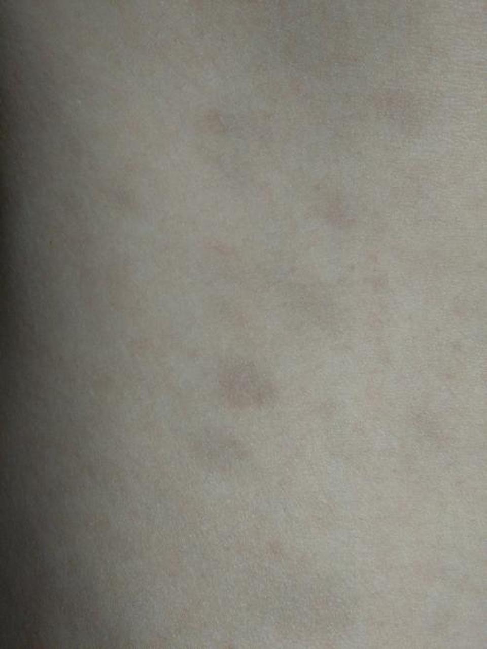 咖啡斑: 遗传,环境等导致,边界清晰,随年龄增长.