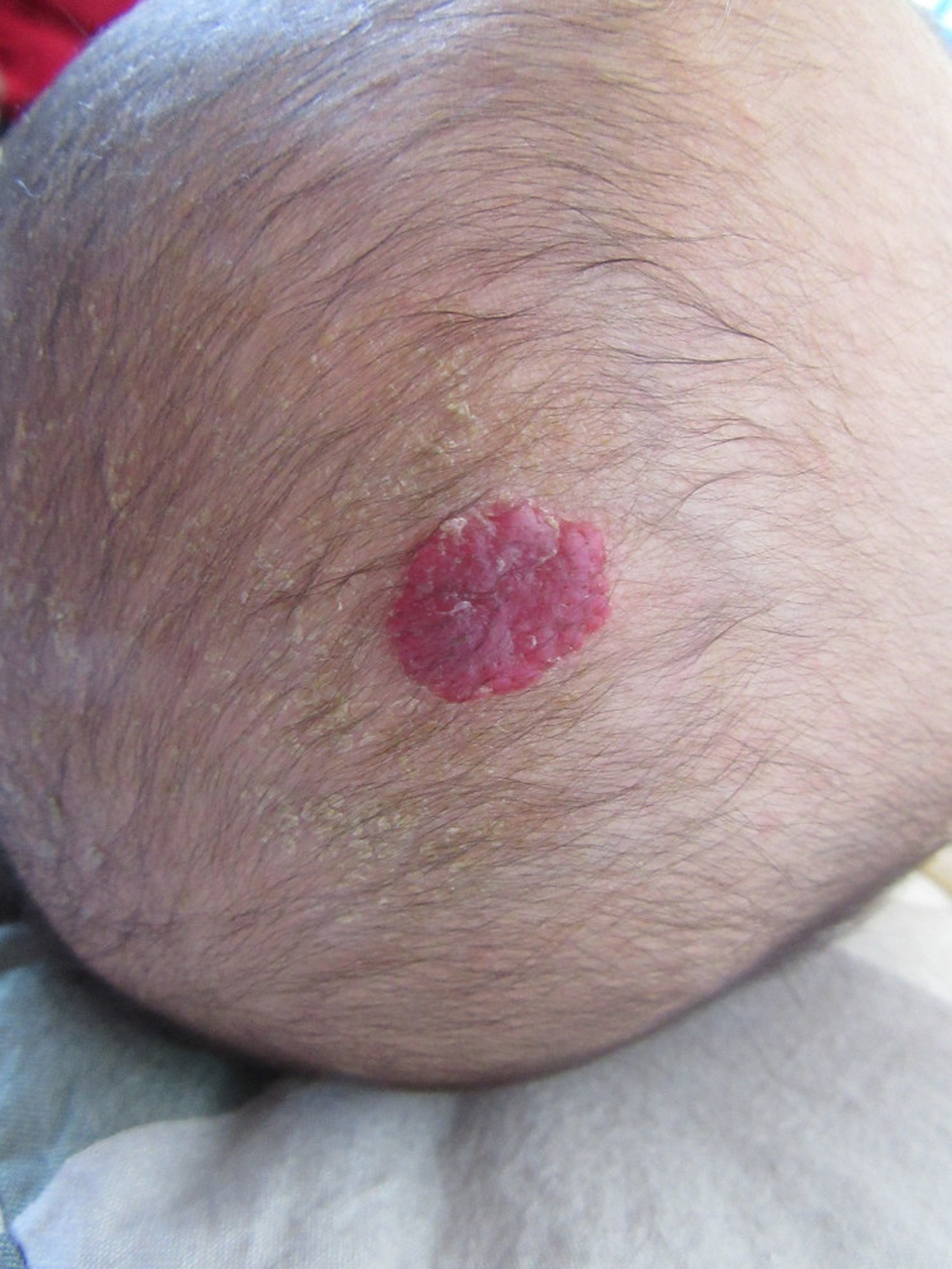 医生,快帮我孩子看看,这是啥子病,怎么几天时间就蔓延这么大,还鼓包?