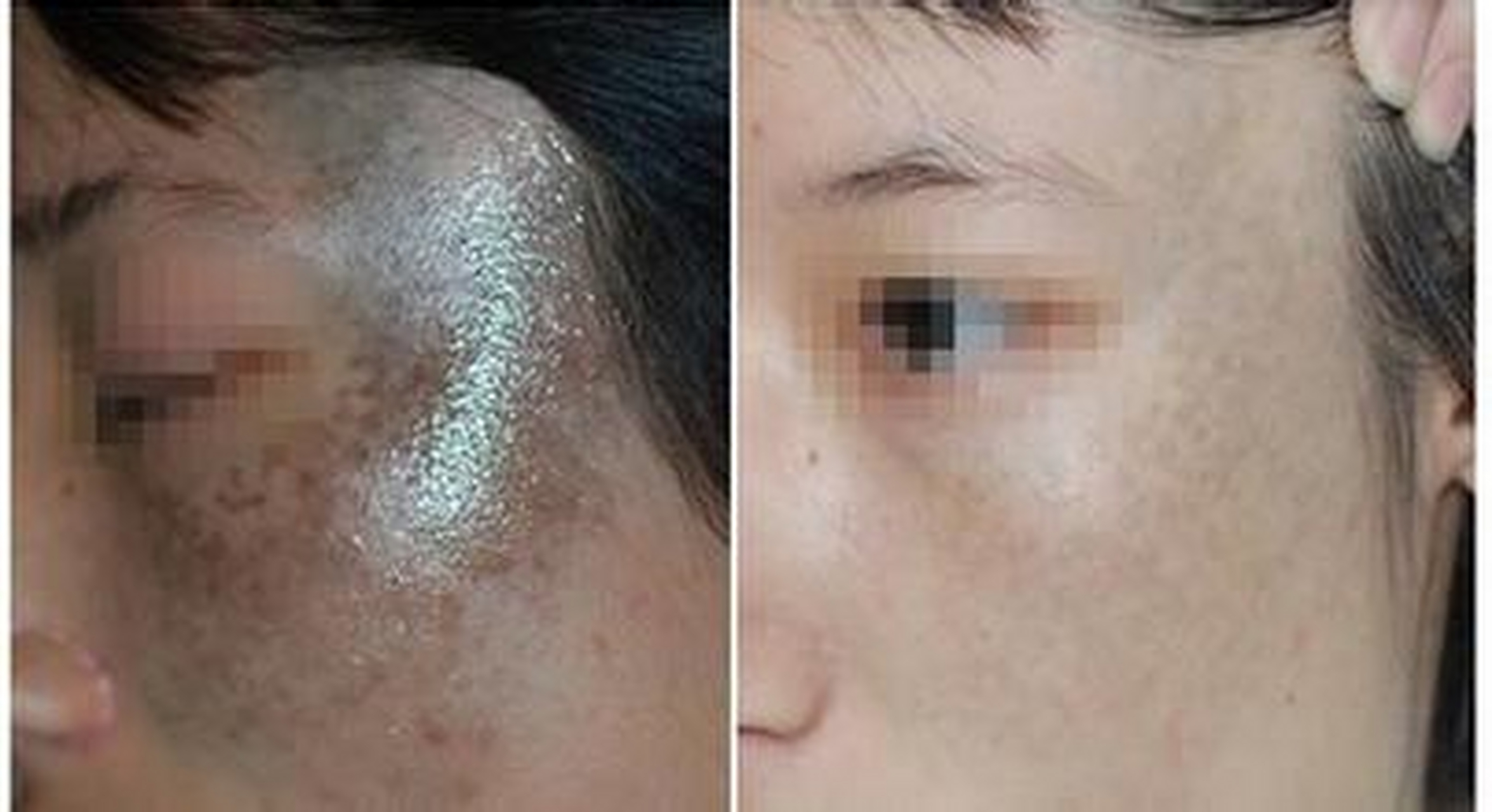 有不少太田痣患者来看的时候,会告诉说,先就是眼睛上长有一点点,眼睑