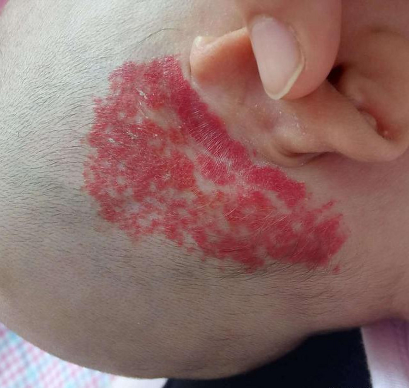 婴儿血管瘤更多表现为红色或紫色高出皮肤的肿块,可像血管一样呈分