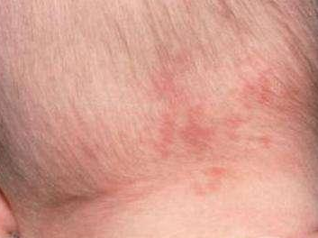 宝宝为什么长胎记