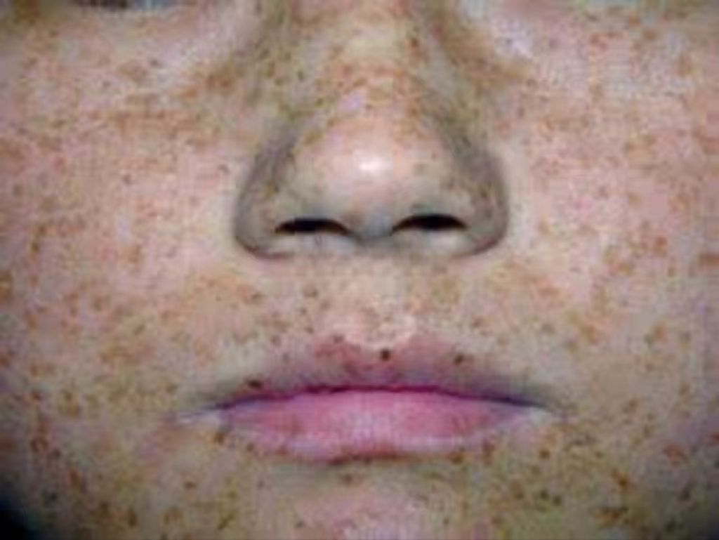 指由自然或人工紫外线照射引起的界限清楚的