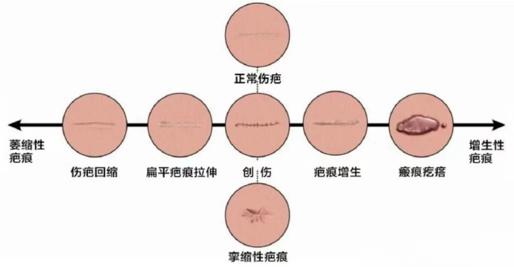 疤痕形成,本质上是伤口的愈合反应过程