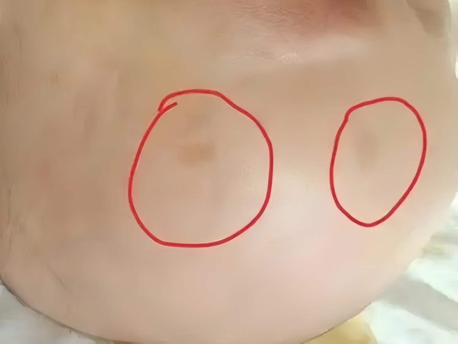 私信答疑环节之咖啡斑常见三问