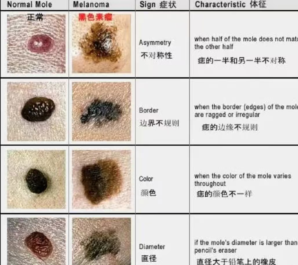 男子脖子上的"大痣"突然发痒,这种情况千万别拖!