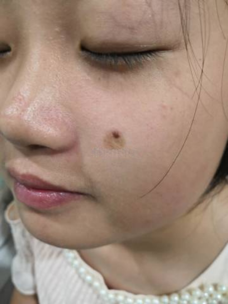 一颗小米大的痣,怎么变成了这样?