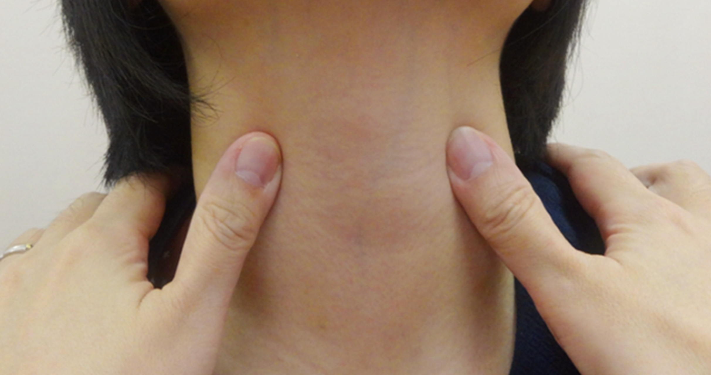 甲亢是一种常见病症,在西医看来,其主要由内分泌失调引发.