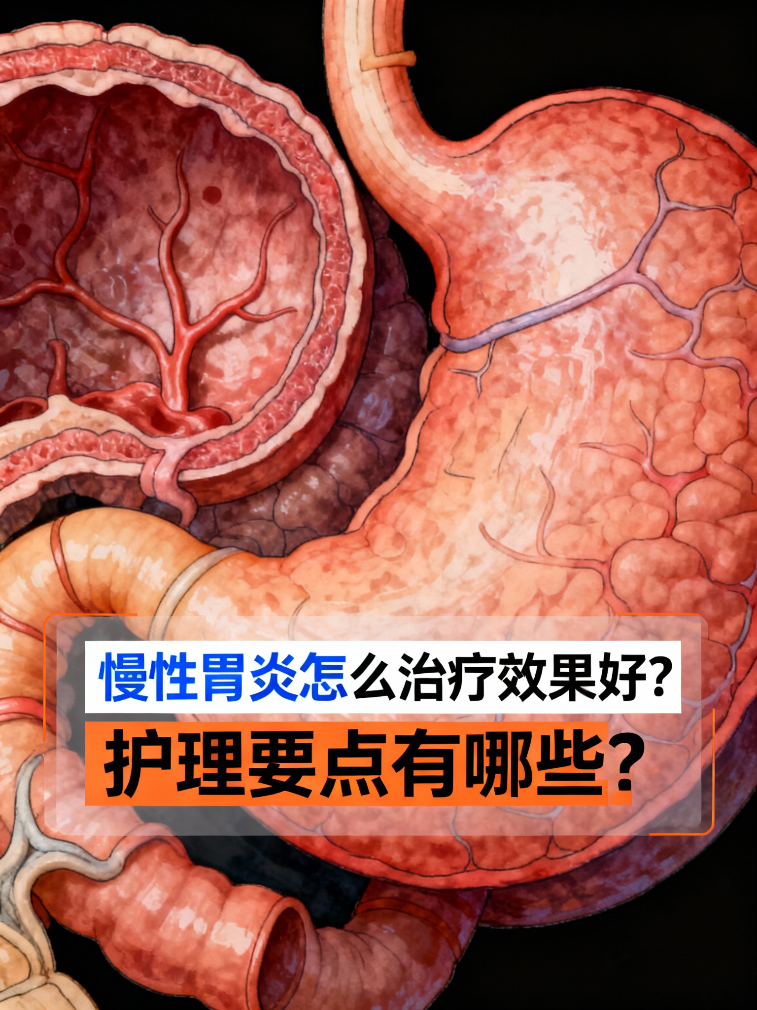 要想慢性胃炎治护理要点 慢性胃炎怎么治疗效果好?护理要点有哪些?