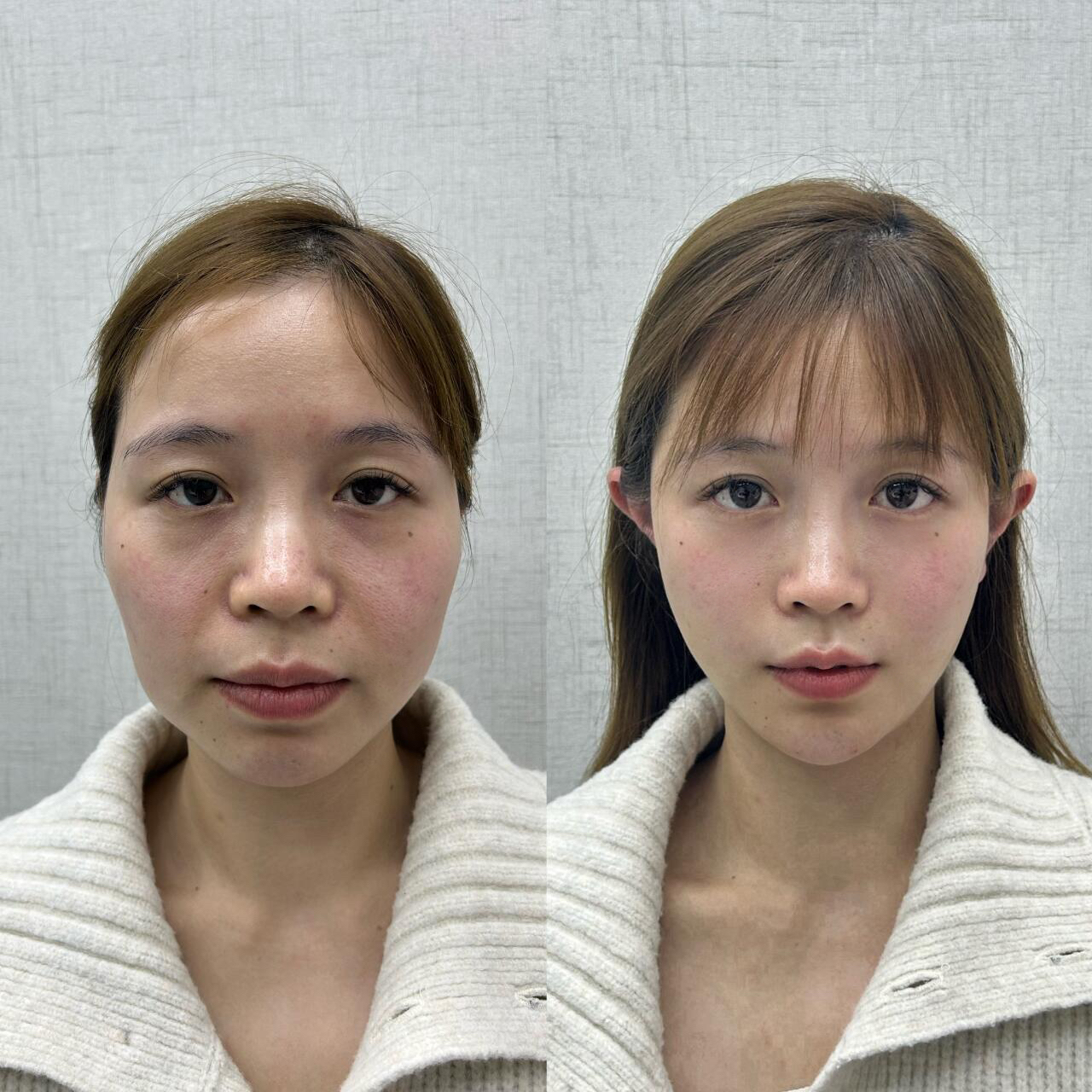 我只做对了1件事  之前对医美不是那么了解,所以一味填充脂肪玻尿酸