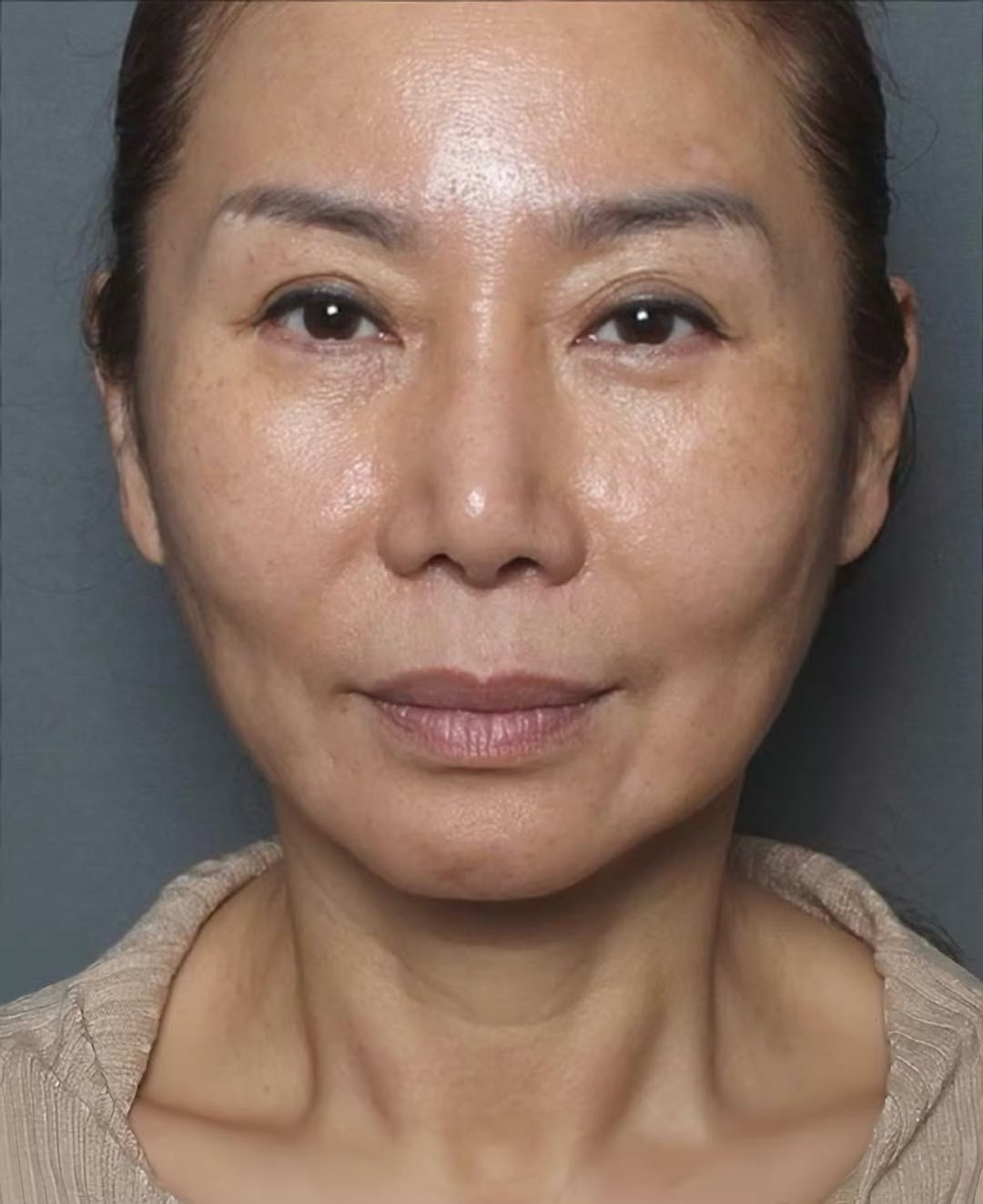 做6次线雕,热玛吉,不如一次实在的"无痕筋膜提升"……