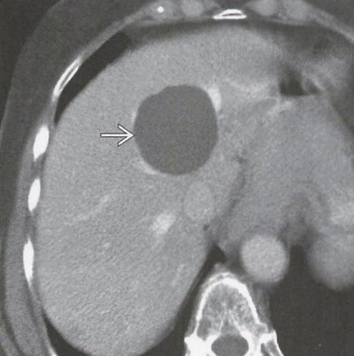 肝血管瘤增强ct表现肝上囊肿和血管瘤有核磁什么区别肝癌的典型超声