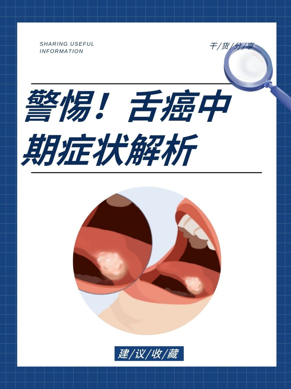 舌癌中期症状解析   93舌癌的中期主要症状   舌癌的中期主要症状