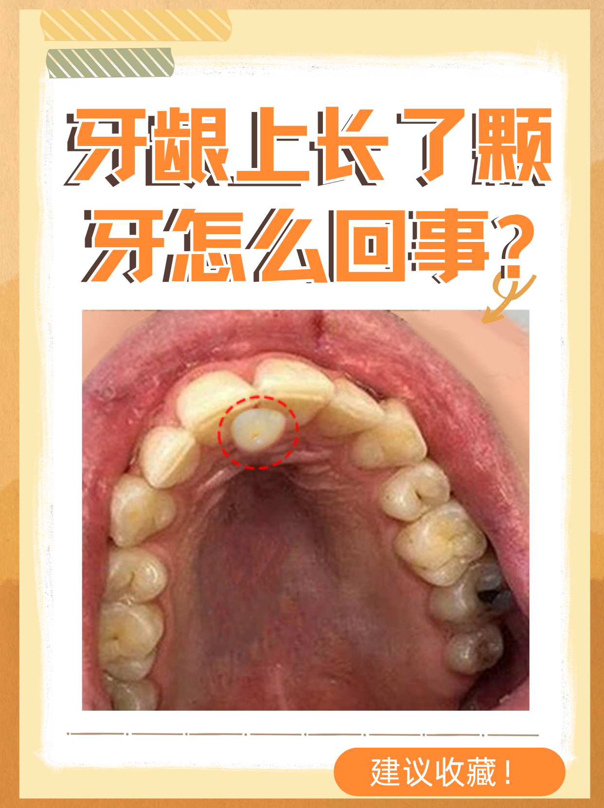 我想告诉大家,这种情况可能是以下几种情况导致牙齿长到牙龈上龈图片
