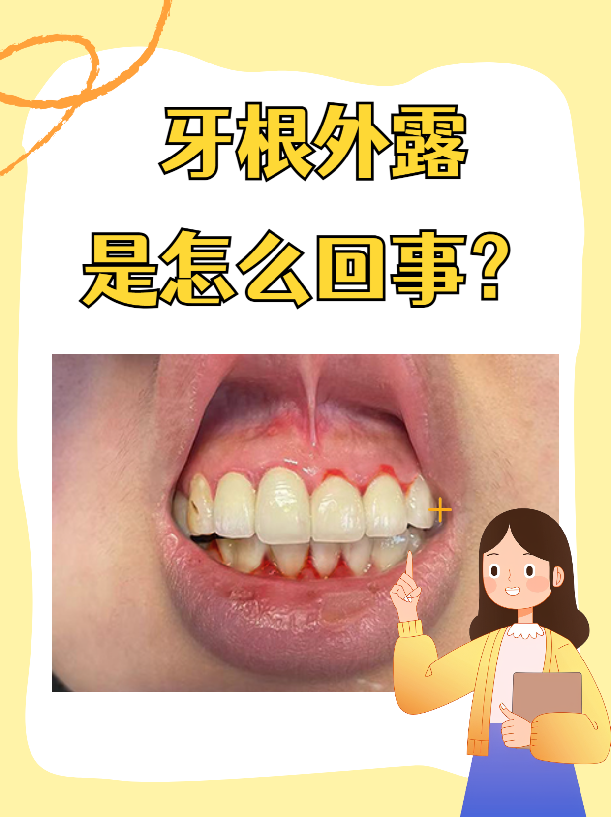 牙根外露是怎么回事?牙齿健康的潜在威胁!