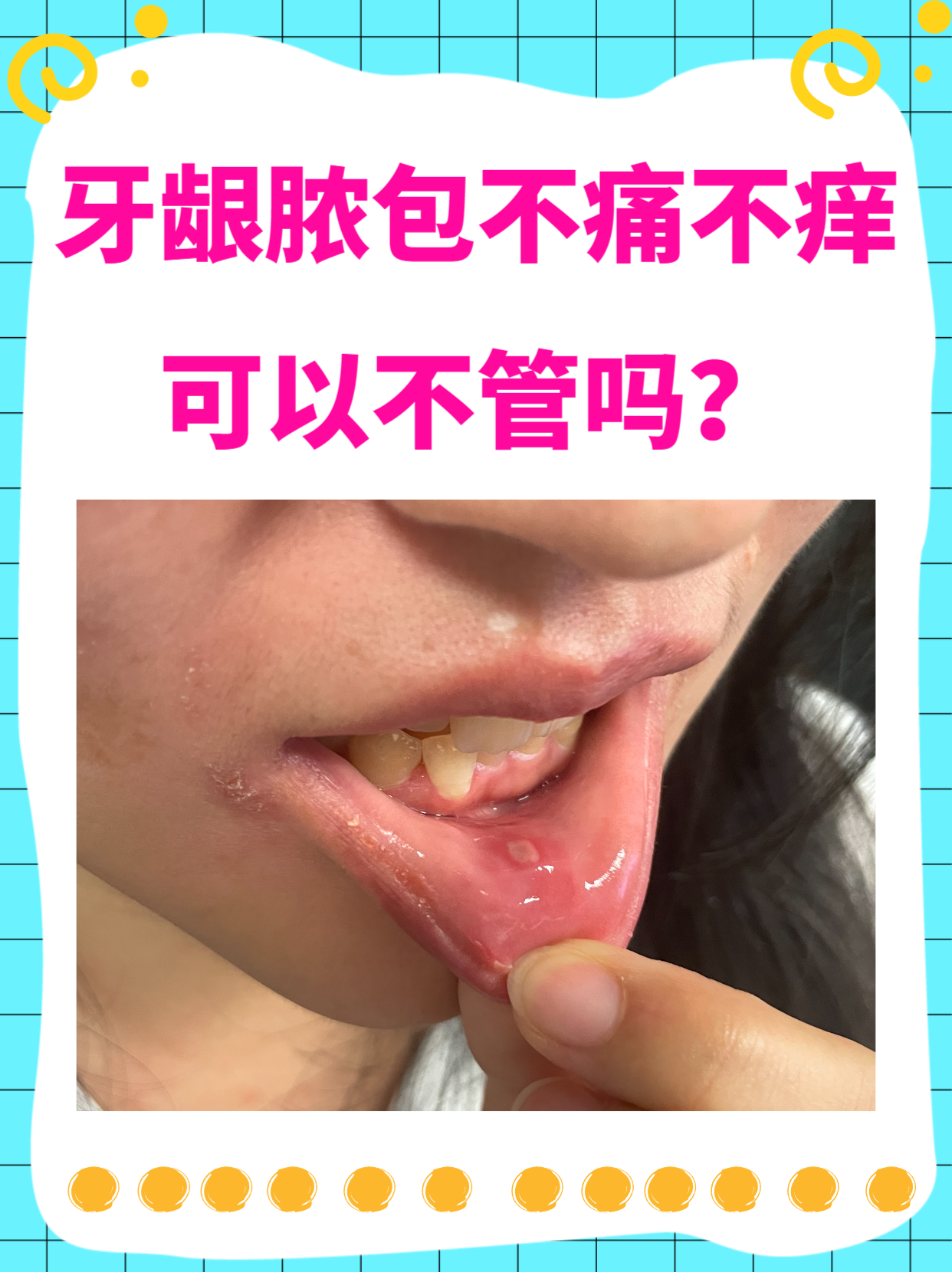 医生警告:别不当回事! 牙龈冒出个脓包,却不痛不痒?