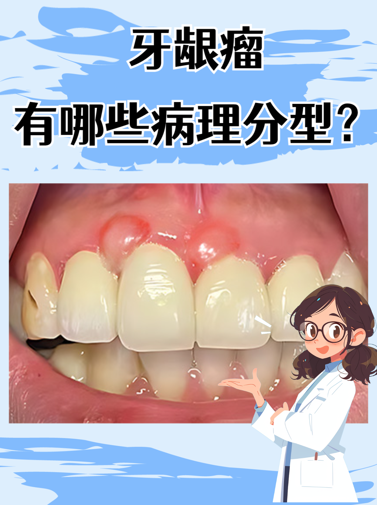 3大病理类型要分清! 牙龈瘤虽然名字里带"瘤",但它并非真正的肿瘤