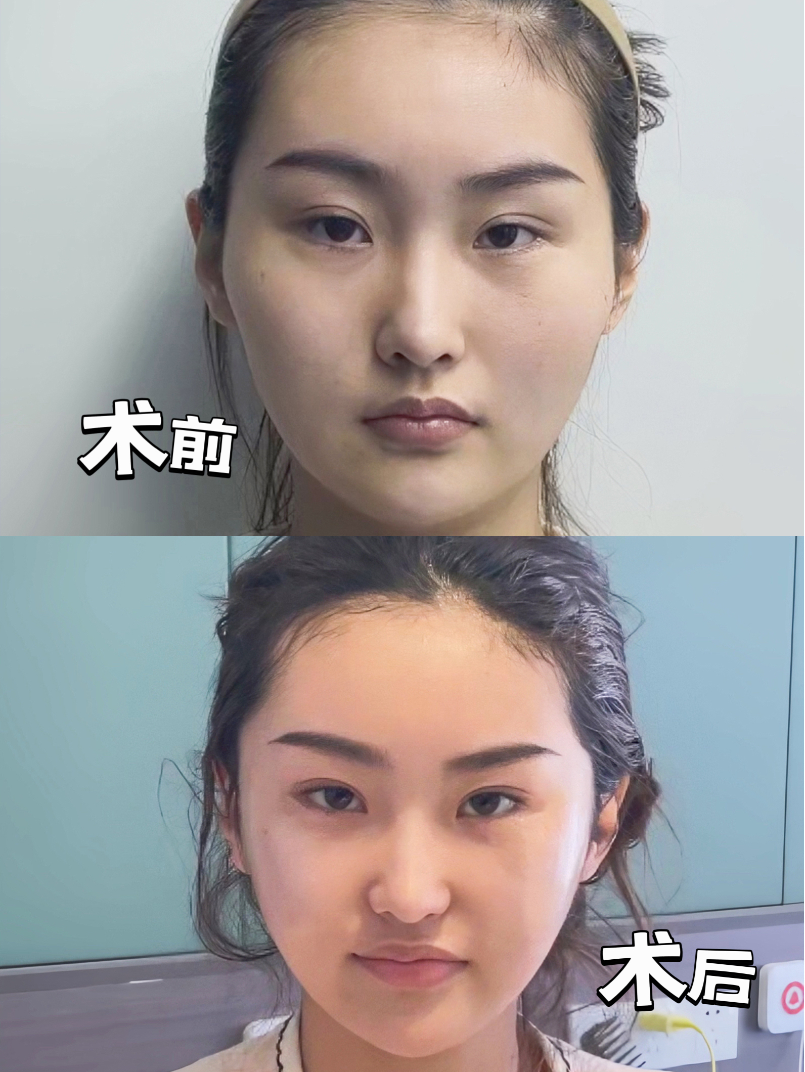 真的怕磨骨老了挂不住肉,纠结中让我找到了不动骨降颧骨,微调变成一眼